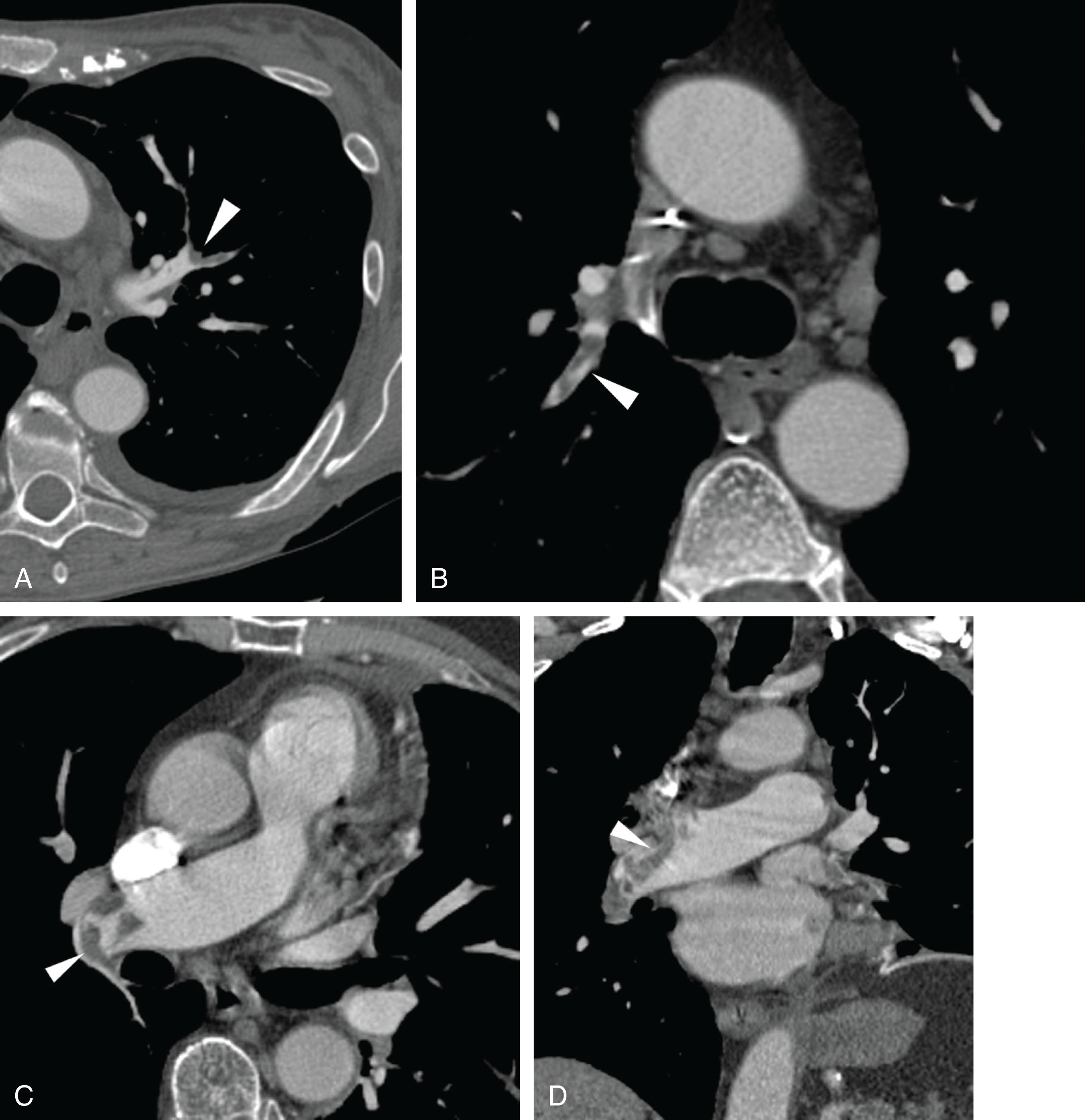 Figure 42.2, Proximal pulmonary embolism. Elongated emboli ( arrowheads in A – D ) often become lodged across more distal vessel branch points, such as at the lobar or segmental levels. These typically have a rounded eccentric appearance compared with the vessel cross-section. If they contact the vessel wall, they form acute angles with it.