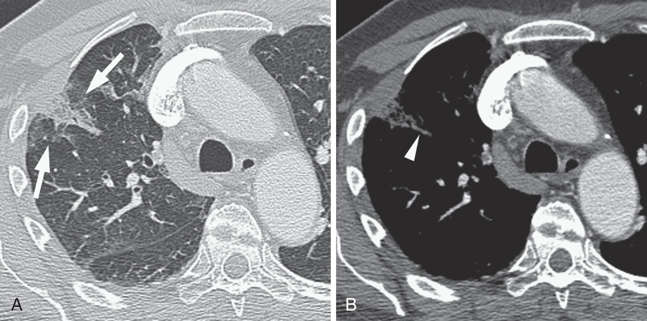 Figure 42.4, Pulmonary infarct. If arterial occlusion is complete, and collateral bronchial arterial flow is inadequate, ischemic injury or infarction occurs in the lung peripheral to the embolism. This causes focal consolidation ( arrows in A ) that is typically wedge-shaped, with the base along the pleural surface and the apex directed toward the affected artery ( arrowhead in B ).