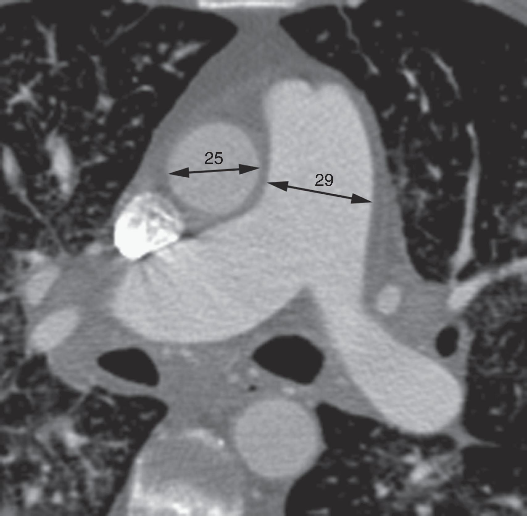 Figure 42.5, The diameters of the main pulmonary artery and aorta are measured at the level of the pulmonary bifurcation. A pulmonary artery diameter greater than 30–33 mm or greater than the diameter of the aorta indicates pulmonary arterial hypertension.