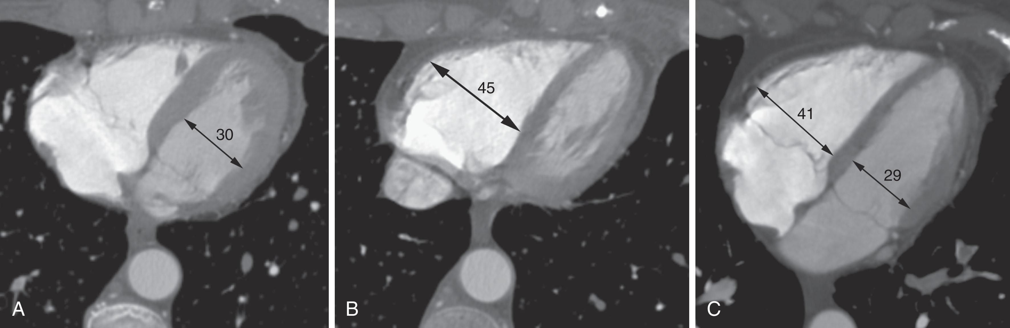 Figure 42.6, The transverse diameters of the left (LV; A ) and right (RV; B ) ventricles are measured at the widest point for each chamber. These are typically at different axial levels. A ratio of RV/LV diameters greater than 1.0:1 to 1.5:1 indicates right ventricular dilatation and dysfunction. C , The measurement can also be made on a single reformatted image in the long-axis view. In this view, the RV/LV ratio should be less than 1.0:1.