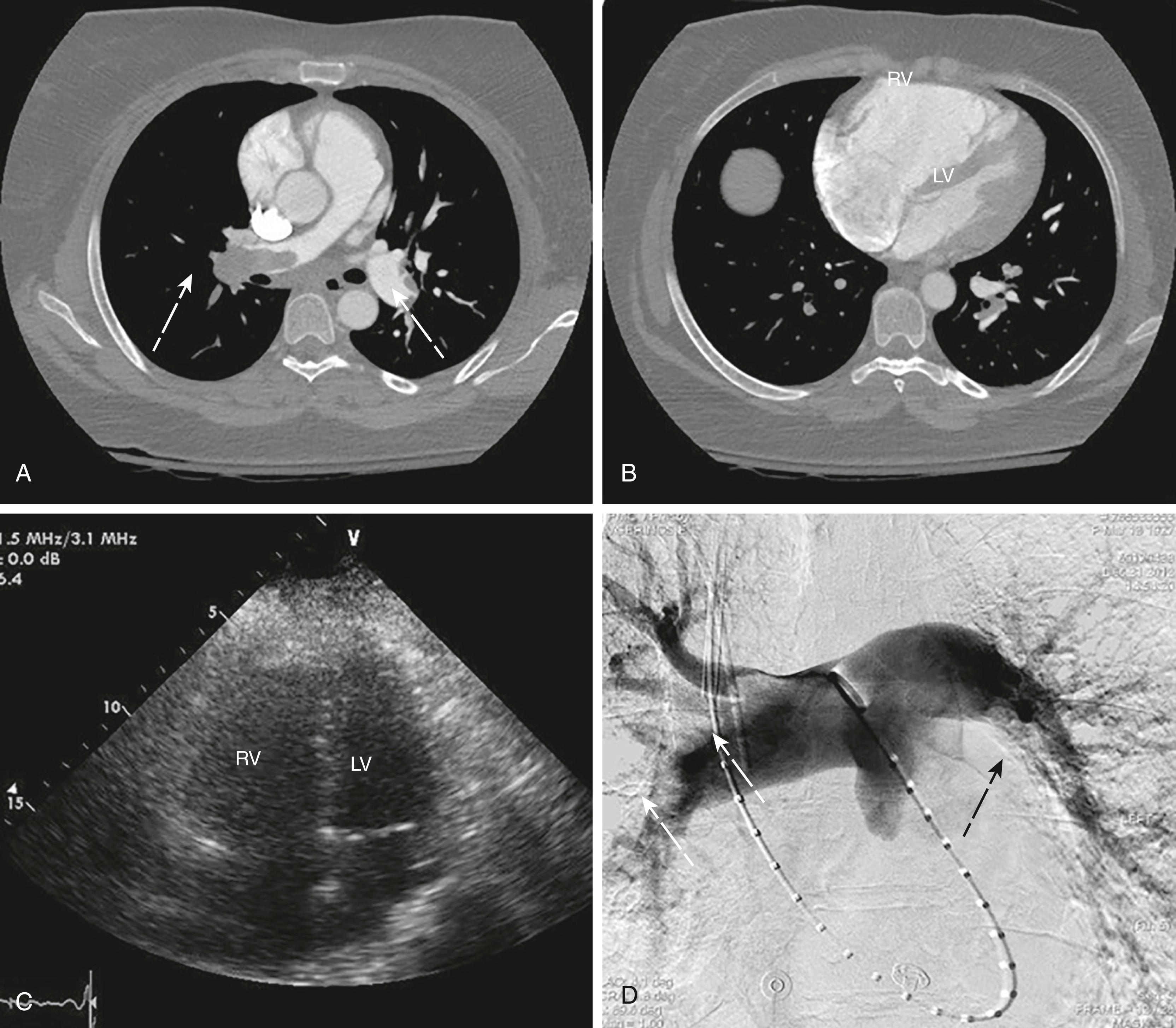 Figure 152.1, Pulmonary Embolism (PE) and Right Ventricular Imaging.