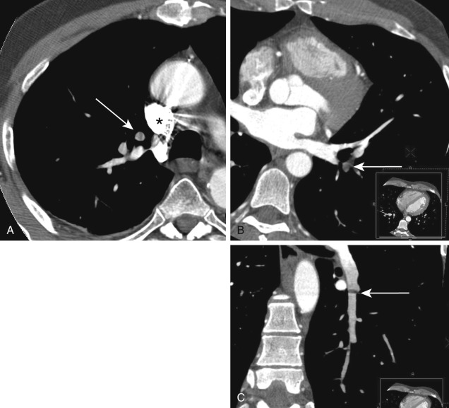 FIGURE 11.11, Pitfalls in the interpretation of computed tomography pulmonary angiography. A, Apparent filling defect in a right upper lobe pulmonary artery (arrow) is caused by a streak or beam-hardening artifact from dense contrast within the superior vena cava (asterisk) . B, Apparent filling defect of a left lower lobe pulmonary artery on axial image (arrow) is confirmed to be secondary to slab or misalignment artifact on the corresponding coronal multiplanar reformation (C) (arrow) . Apparent filling defects perpendicular to the pulmonary artery on corresponding multiplanar reformations are typically artifacts. D, Low-attenuation tubular structures (arrows) in the right lower lobe could be misidentified as filling defects in the pulmonary arteries, but the pulmonary arteries can be seen posterior and lateral to these structures. The tubular low-attenuation structures are mucous plugs within right lower lobe segmental bronchi. E, Mucous plugging is confirmed on the corresponding axial image in lung windows.