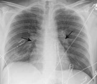 FIGURE 11.12, Pulmonary artery thrombolysis catheters. Frontal chest radiograph demonstrating pulmonary artery thrombolysis catheters in the main pulmonary artery extending into both lower lobe pulmonary arteries (arrows) .