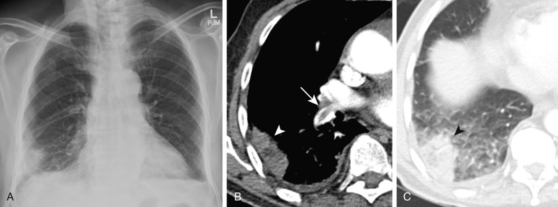 FIGURE 11.3, Pulmonary infarct and Hampton hump. A, Frontal chest radiograph demonstrates a wedge-shaped opacity in the right lower lung near the costophrenic sulcus, abutting the pleura (Hampton hump). B, Axial computed tomography (CT) image on mediastinal windows demonstrates a filling defect in the right lower lobe pulmonary artery (arrow) and a wedge-shaped area of consolidation abutting the pleura (arrowhead) . C, Axial CT image on lung windows shows a wedge-shaped area of consolidation abutting the pleura (arrowhead) consistent with an infarct. A small right pleural effusion is noted.