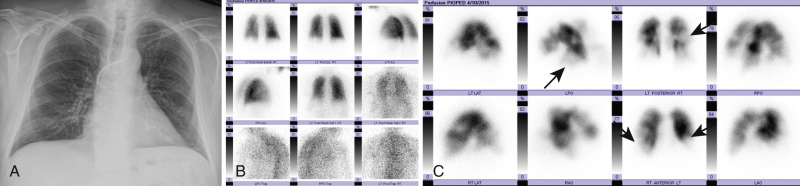 FIGURE 11.4, Pulmonary embolism on ventilation/perfusion scan. A, Frontal chest radiograph in a patient presenting with shortness of breath after heart transplantation demonstrates clear lungs. Incidental note is made of a retained implantable cardioverter defibrillator (ICD) lead fragment. B, Ventilation images appear normal. C, Perfusion images demonstrate several bilateral moderate and large perfusion defects (arrows) with no matching defects on the ventilation images or on the recent chest radiograph, consistent with a high probability of pulmonary embolism.