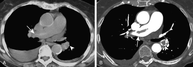 FIGURE 11.5, Pulmonary embolism on noncontrast and contrast-enhanced chest computed tomography (CT) scan. A, Axial noncontrast CT image demonstrates a hyperattenuating filling defects in the right main (arrow) and left lower lobe (arrowhead) pulmonary arteries. B, These were confirmed to be pulmonary emboli on CT pulmonary angiography. Small pleural effusions are noted bilaterally.