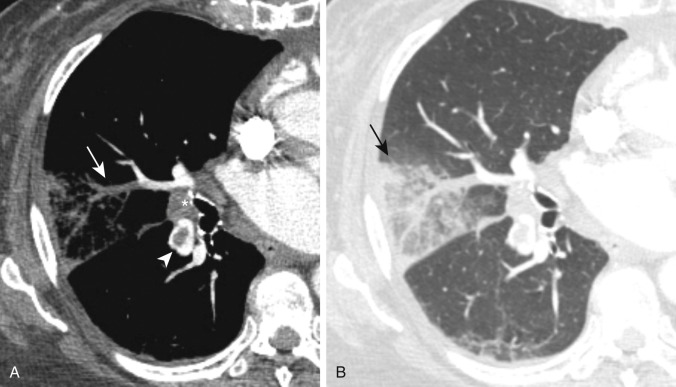 FIGURE 11.7, Pulmonary infarct. A, Axial computed tomography image on mediastinal windows demonstrates complete occlusion of a subsegmental right middle lobe pulmonary artery (arrow) and a central filling defect in the right lower lobe pulmonary artery (polo mint sign) (arrowhead) . Note is made of a right hilar lymph node (asterisk) . B, Corresponding axial image on lung windows demonstrates a wedge-shaped ground-glass opacity distal to the occluded right middle lobe pulmonary artery, consistent with a pulmonary infarct (arrow) .