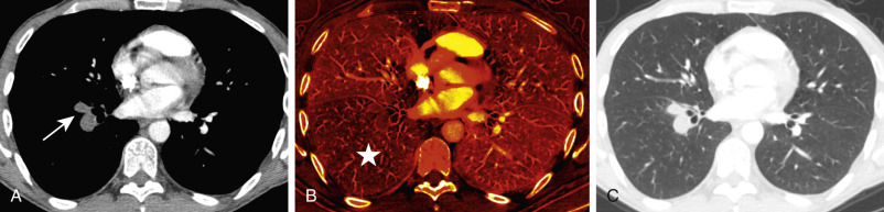 FIGURE 11.8, Pulmonary embolism on dual-energy computed tomography. A, Axial image on mediastinal windows depicting filling defects and complete occlusion of two right lower lobe pulmonary arteries (arrows) . B, Perfusion map demonstrates decreased perfusion of the right lower lobe (star) compared with the remainder of the lungs. C, There is no corresponding abnormality of the lung parenchyma on lung windows.