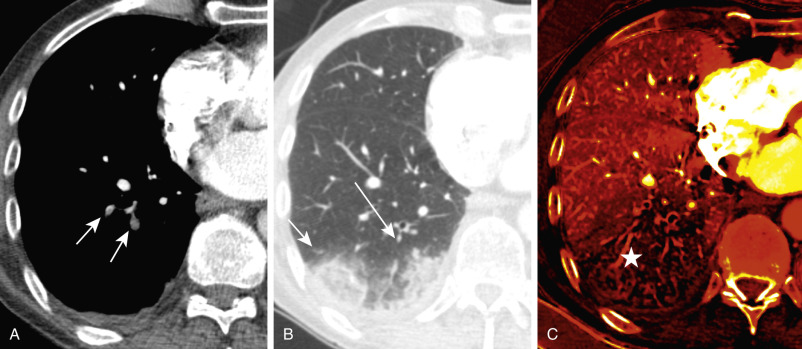 FIGURE 11.9, Pulmonary embolism and infarct on dual-energy computed tomography (CT). A, Axial image shows filling defects in two right lower lobe pulmonary arteries (arrows) . B, Axial image demonstrates two peripheral wedge-shaped ground-glass opacities (infarcts) (arrows) . C, The perfusion map demonstrates decreased perfusion in the right lower lobe (star) , which involves a larger area of the lung parenchyma than the ground-glass opacity associated with the infarcts, representing a mismatch. An area of decreased perfusion on the perfusion map that is larger than the CT opacity is a typical finding in pulmonary embolism with infarct. In cases of pneumonia, the area of decreased perfusion on dual-energy CT is of similar size to the area of consolidation.