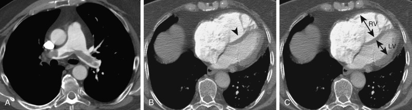 FIGURE 11.10, Saddle embolus and right heart strain. A, Axial image depicts a saddle embolus. B, Axial image through the heart shows a right ventricle–left ventricle (RV/LV) ratio greater than 1. There is also bowing of the interventricular septum toward the left ventricle (arrowhead) . These findings are consistent with right heart strain. C, The same image as B shows the measurements used to calculate the RV/LV ratio, which is greater than 1 on this image. Sometimes the widest diameter from the interventricular septum to the inner surface of the ventricular free wall may be different on different images at different levels.