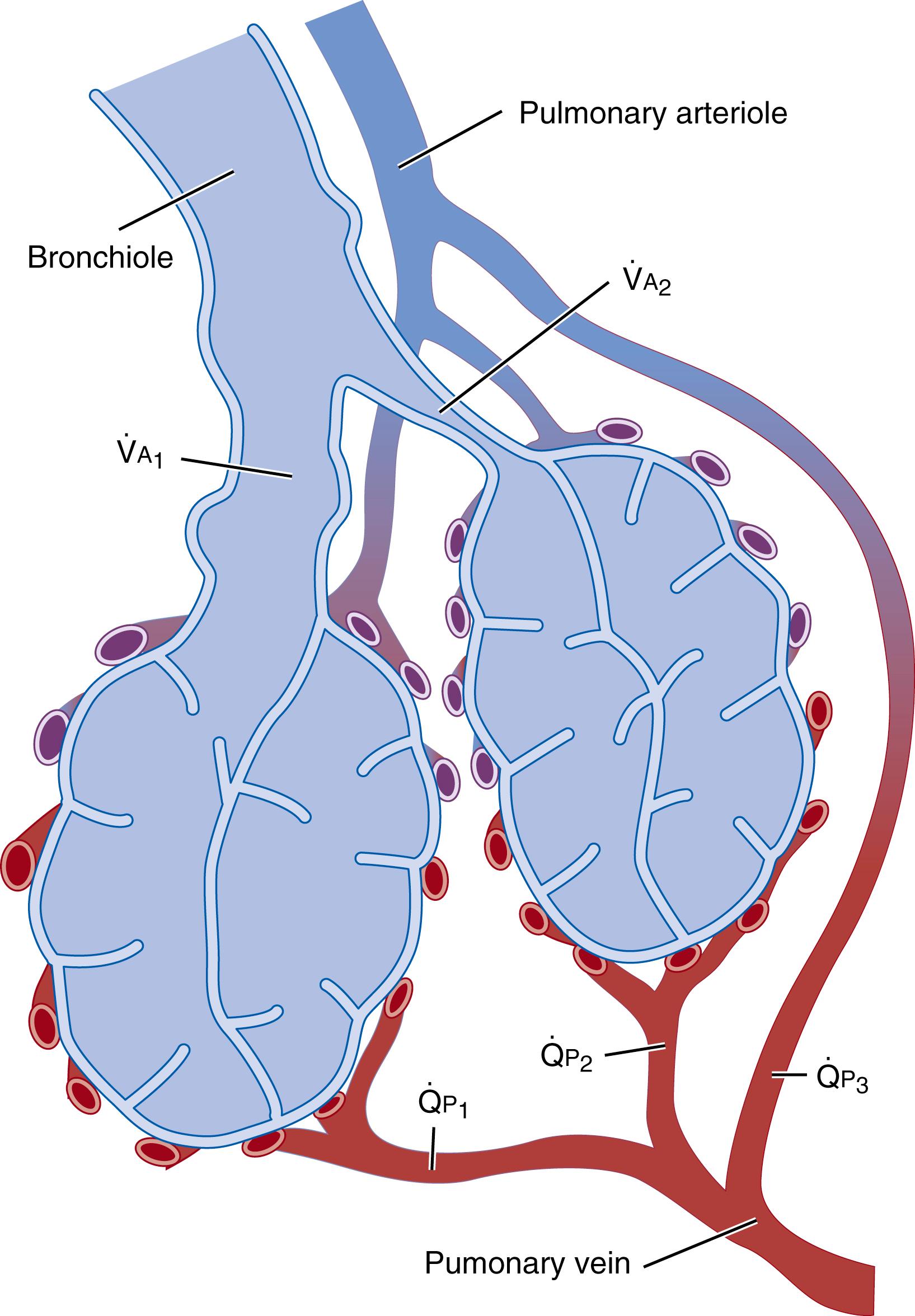 Fig. 64.2, Airway and vascular relationships. The acinar unit, containing many alveolar sacs, is shown with multiple pulmonary capillaries enveloping the saccules, providing the maximal gas-exchanging surface area. V˙A1/Q˙P1 V˙A1/Q˙P1 corresponds to an acinar region (containing multiple alveoli) with normal V˙A/Q˙P V˙A/Q˙P ; V˙A2/Q˙P2 V˙A2/Q˙P2 represents an acinar region with a low V˙A/Q˙P V˙A/Q˙P and poor gas exchange. The pulmonary arteriole to pulmonary venous connection Q˙P3 Q˙P3 , which bypasses any air-containing spaces, could represent intrapulmonary as well as extrapulmonary shunts.