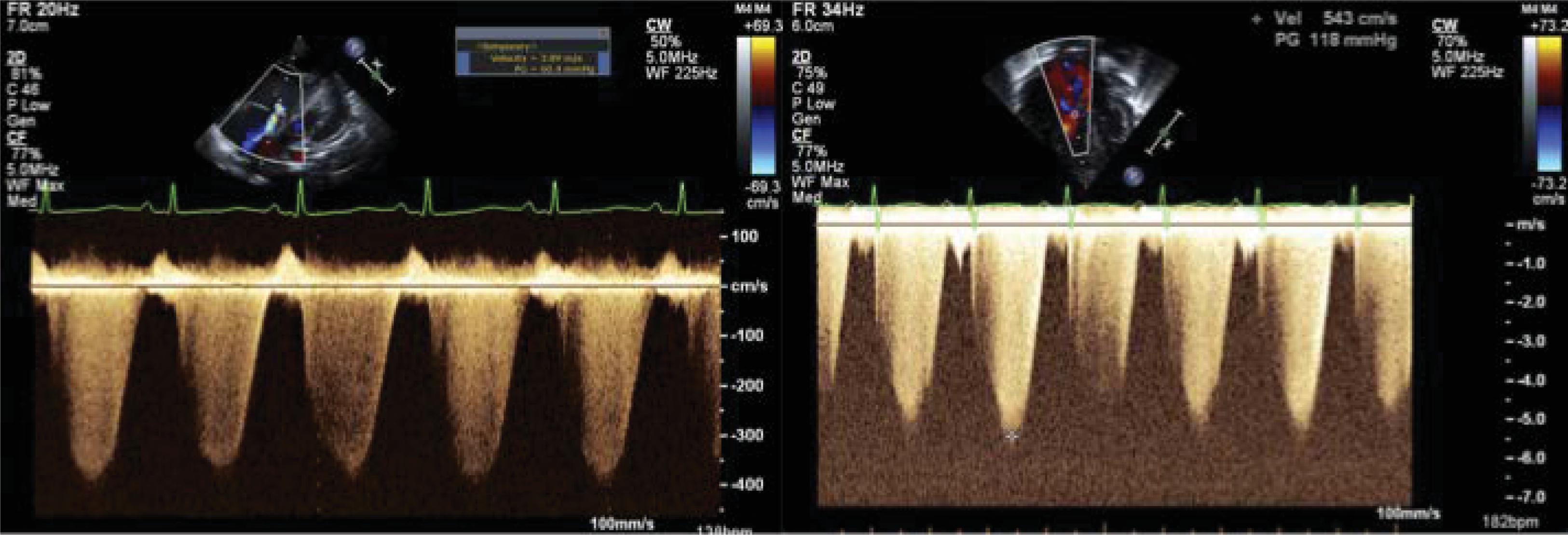 Fig. 40.1, Tricuspid Regurgitant Jet Velocity.