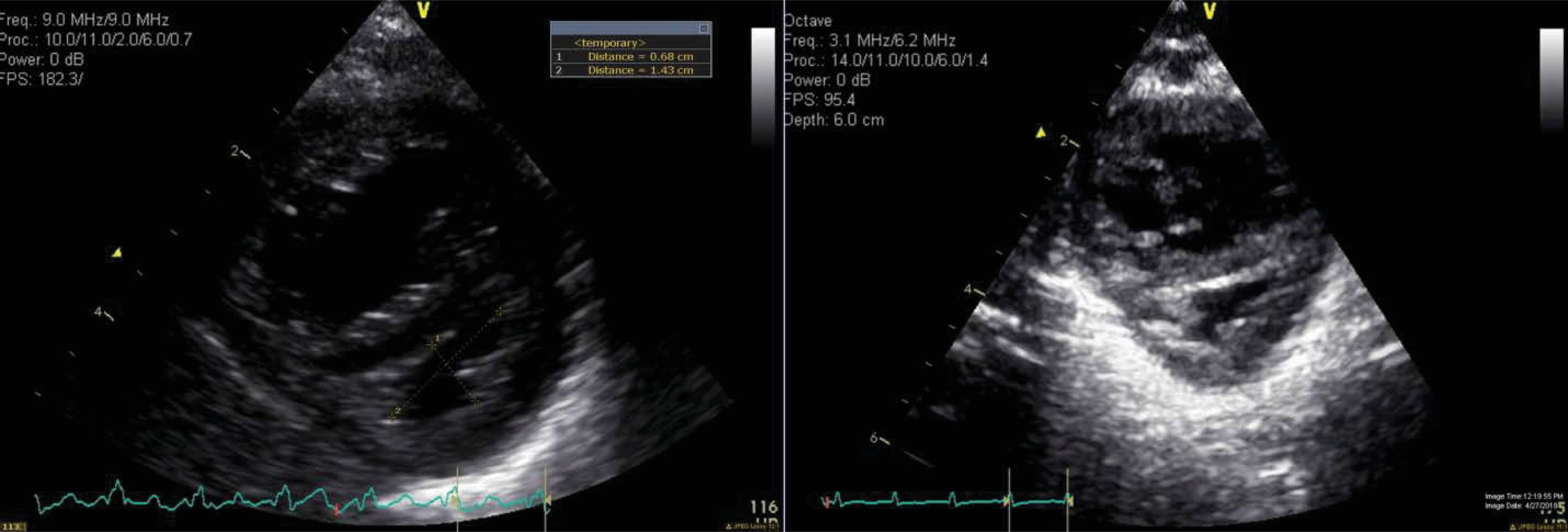 Fig. 40.4, Septal Configuration.