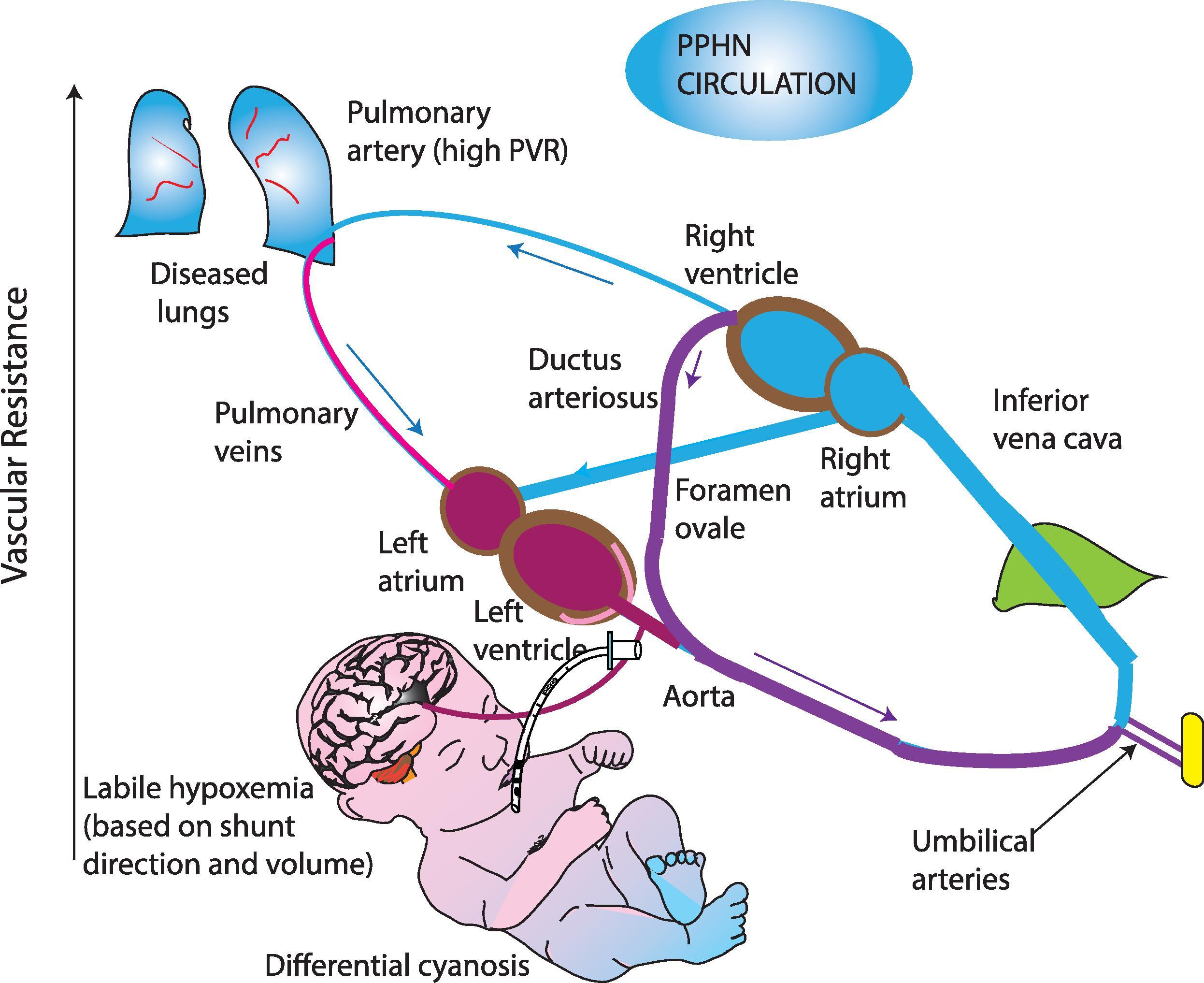 Fig. 13.1, Pathophysiology of Pulmonary Hypertension of the Newborn .
