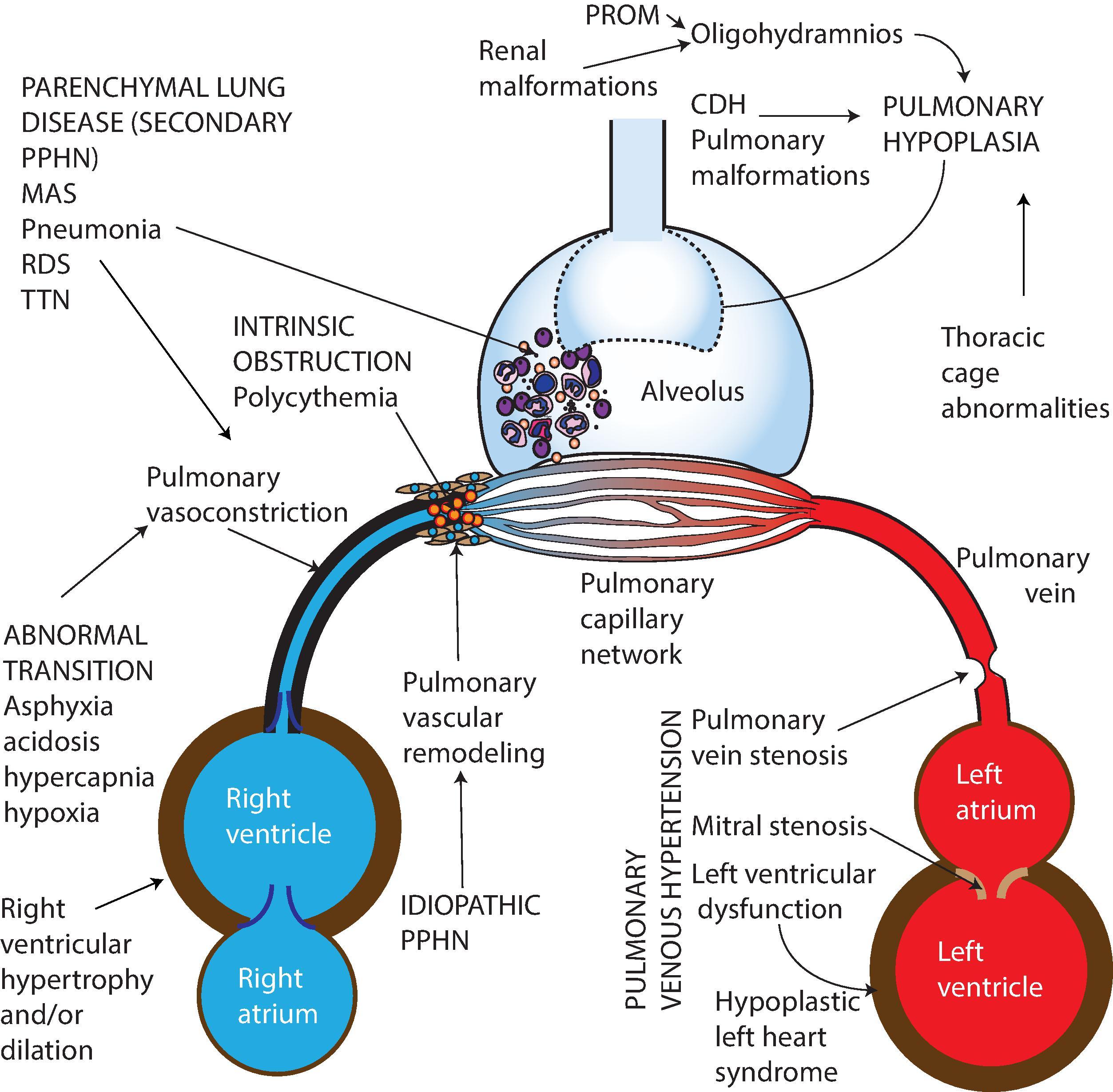 Fig. 13.3, Etiology of Pulmonary Hypertension of the Newborn .