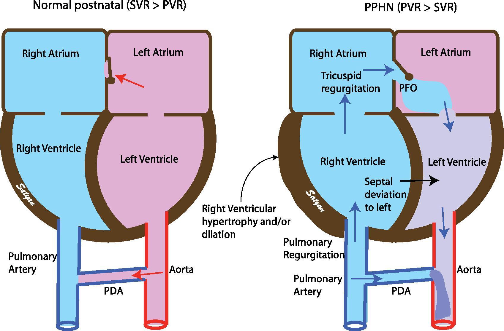 Fig. 13.4, Echocardiographic Features of Pulmonary Hypertension of the Newborn .