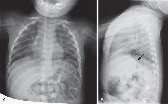 Figure 54.1, Respiratory syncytial virus pneumonia in a 1.5-year-old boy.