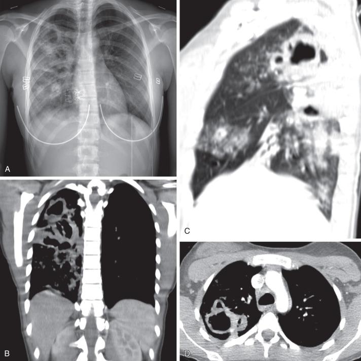 e-Figure 54.10, Staphylococcus aureus pneumonia in a 15-year-old girl who presented with a 3-day history of fever, cough, fatigue, and vomiting.