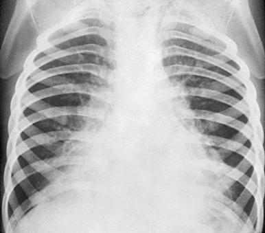 e-Figure 54.12, Pertussis bronchopneumonia.