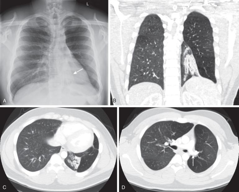 e-Figure 54.2, Swyer–James–MacLeod syndrome in a 20-year-old man monitored since early childhood; he had chronic left lower lobe collapse and bronchiectasis secondary to bronchiolitis obliterans after an adenovirus infection.