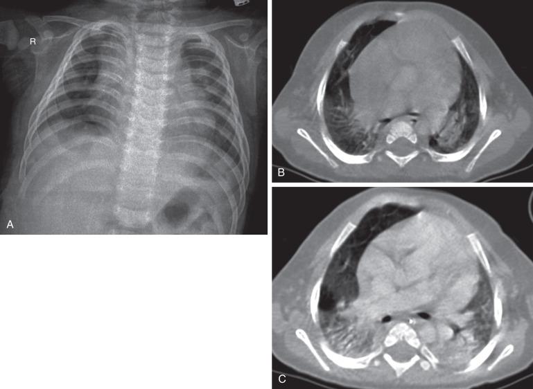 e-Figure 54.3, Lethal H1N1 influenza in an 8-month-old boy who presented with shortness of breath and fever during an outbreak of epidemic flu.