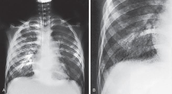 e-Figure 54.4, A 12-year-old girl with leukemia and measles pneumonia.