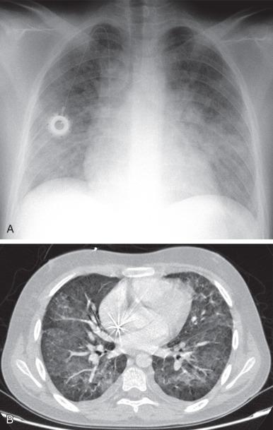 e-Figure 54.5, Cytomegalic virus infection in a 14-year-old boy with acute lymphoblastic leukemia and immunodeficiency, presenting with dyspnea, fever, cough, and decreased white blood cell counts.