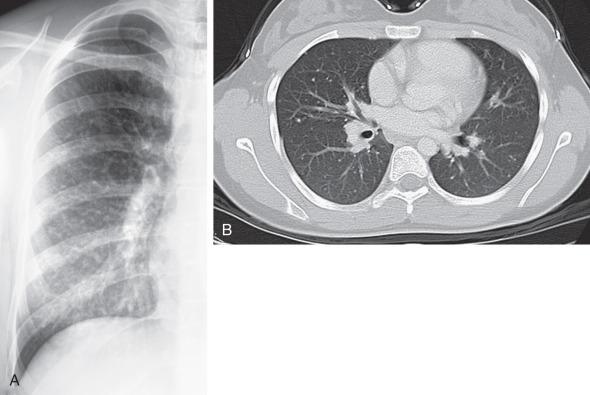 e-Figure 54.6, Chickenpox pneumonia in a teenager.