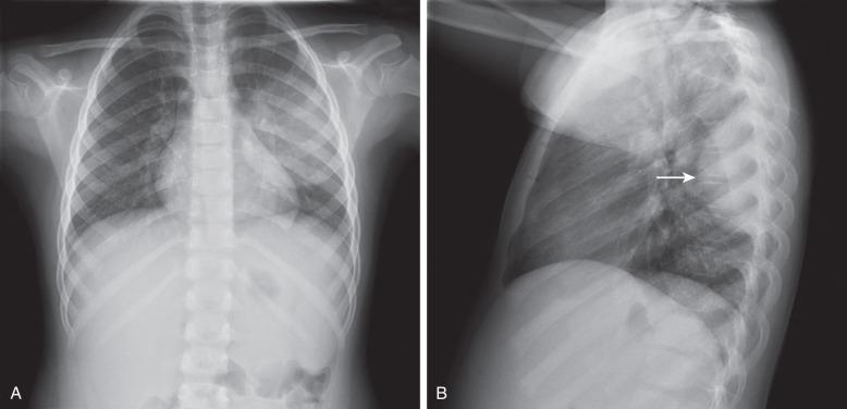 Figure 54.8, Streptococcal round pneumonia in a 5.5-year-old girl presenting with fever and left-sided back and rib pain.