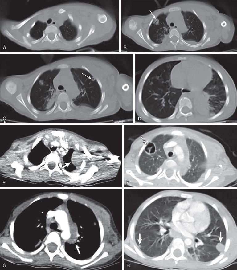 e-Figure 54.9, Staphylococcus aureus septicemia in 4-year-old male Syrian refugee, who presented with loss of consciousness, dyspnea, fever, and swelling in the left axilla and right forehead. The swelling in the right forehead was punctured and a purulent discharge was observed.