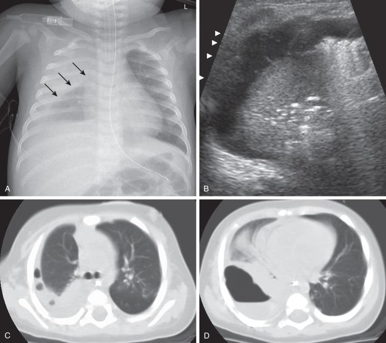Figure 54.11, Role of cross-sectional imaging in a 7-month-old girl with staphylococcal pneumonia and empyema.