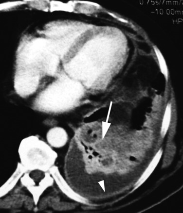 Fig. 5.12, Pleuropulmonary Actinomycosis.