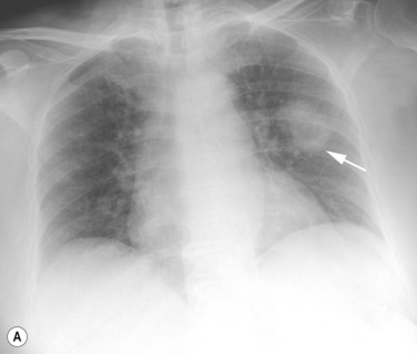 Fig. 5.2, Round Pneumonia.