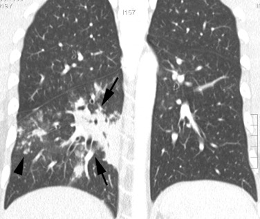 Fig. 5.3, Bronchopneumonia Caused by Haemophilus influenzae .