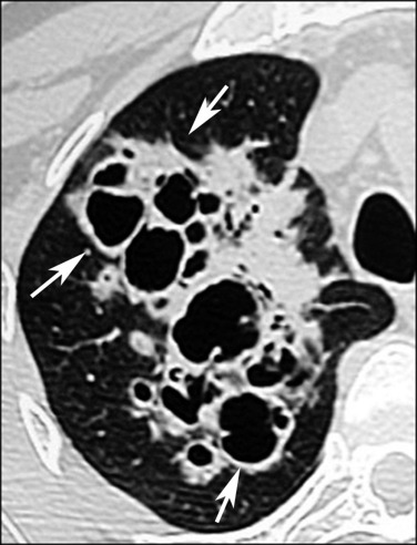 Fig. 5.5, Pneumocystis Pneumonia and Cysts.