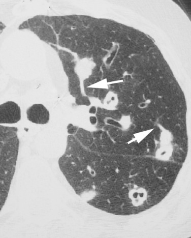 Fig. 5.6, Septic Embolism.