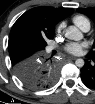 Fig. 5.7, Lobar Pneumoccocal Pneumonia.