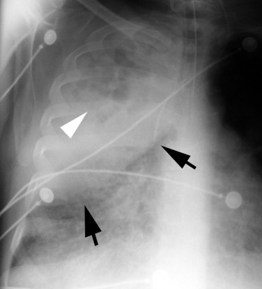 Fig. 5.8, Klebsiella Pneumonia.