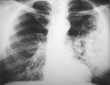 Fig. 5.9, Legionella Pneumonia.