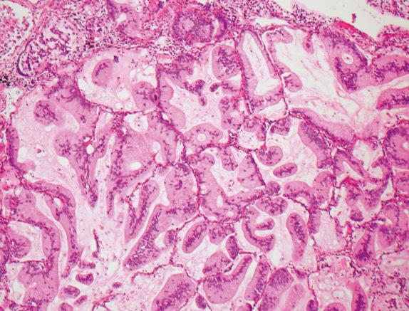 FIG. 29.2, Metastasis with lepidic growth pattern. Patient with pancreatic adenocarcinoma who developed multiple lung nodules. Several of the nodules were composed of mucinous cells lining intact alveolar septa.