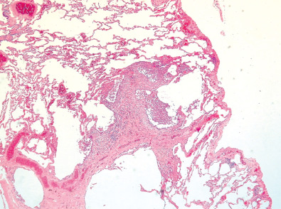 Fig. 33.1, Pulmonary Langerhans cell histiocytosis. Low-power view shows interstitial thickening, increased cellularity, and cystic spaces.