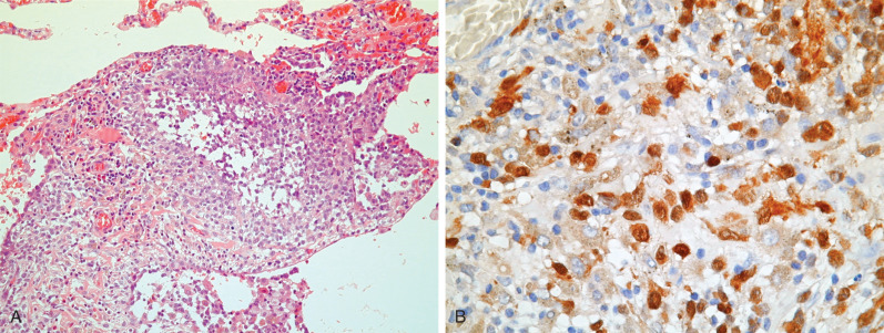 Fig. 33.2, Pulmonary Langerhans cell histiocytosis. High-power view (A) shows Langerhans cells, which stain positively for CD1a on immunohistochemistry (B).