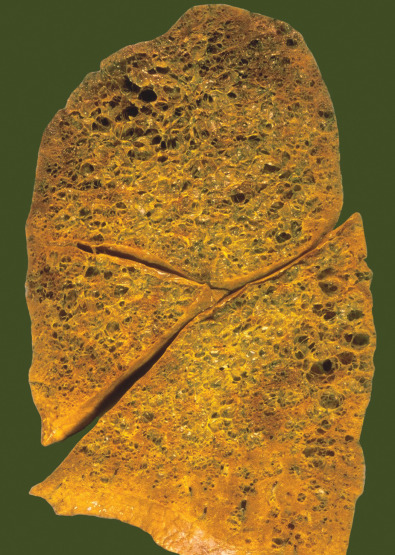 Fig. 33.3, Pulmonary Langerhans cell histiocytosis. Sagittal slice of the right lung shows numerous cystic spaces, most measuring about 0.5–1 cm in diameter. They are present in the central and peripheral regions and are more evident in the upper lobe and superior portions of the lower and middle lobes. Note relative sparing of the tip of the right middle lobe and the lung bases.