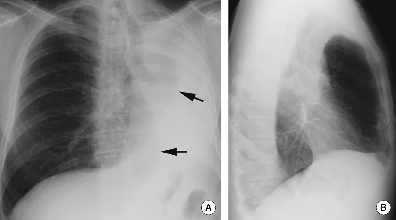 Total left lung collapse. (A) PA and (B) lateral CRXs. The cause of the collapse is a bronchogenic carcinoma ▸ the endobronchial component is visible as an abrupt cut-off of the left main bronchus. Note the marked displacement of the right lung anteriorly and posteriorly across the midline (arrows). Note the marked anterior hyperlucency of the thorax on the lateral view (B). *