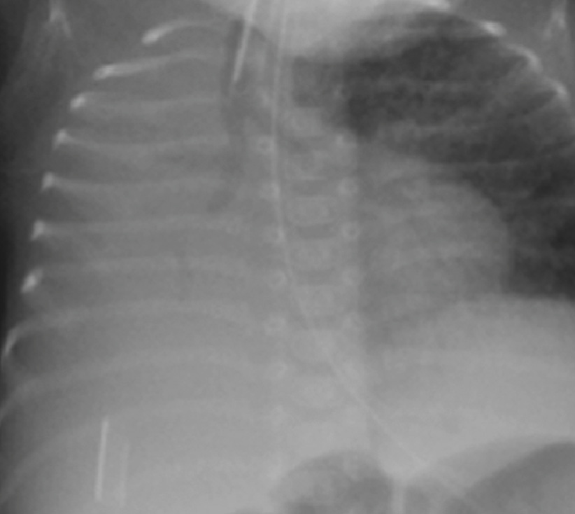 Total right lung collapse in a neonate. The patient was ventilated for respiratory distress syndrome and the cause of the total lung collapse was a mucous plug. *