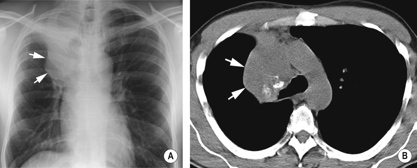 Golden's S sign. (A) PA CXR – a right upper lobe collapse demonstrating peripheral concavity and central convexity (arrows) due to an underlying bronchogenic carcinoma resulting in a reverse S shape. (B) CT demonstrating a convex border of the collapsed lobe (arrows) which is the CT equivalent of Golden's S sign. *