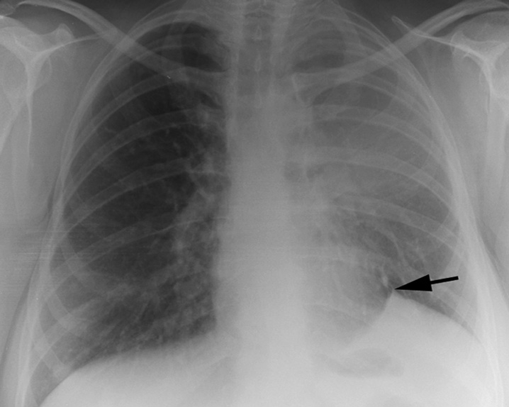 Juxtaphrenic peak sign. A small triangular density (arrow) is seen in a left upper lobe collapse. The sign is due to reorientation of an inferior accessory fissure. *