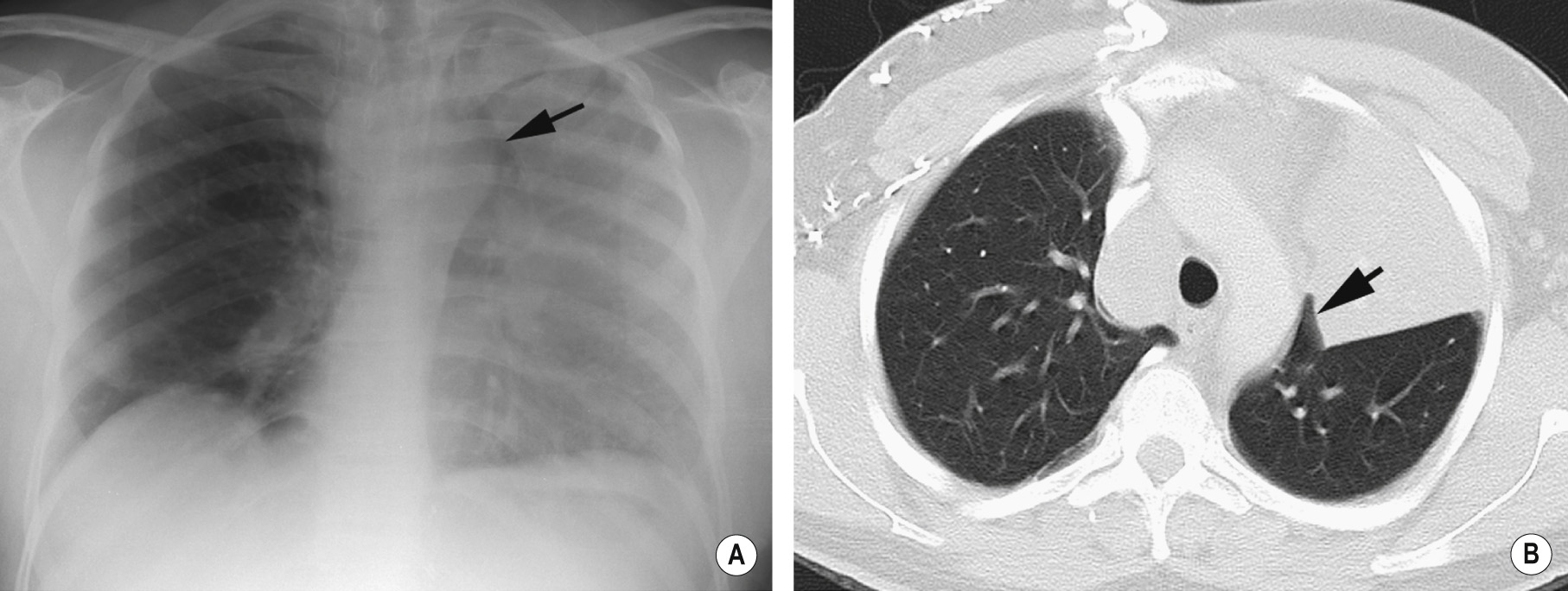 Luftsichel sign. (A) A left upper lobe collapse demonstrating paramediastinal lucency (arrow). (B) CT shows interposition of aerated lung between the collapse and the mediastinum (arrow). There is also a large right paratracheal node causing some distortion of the SVC. *