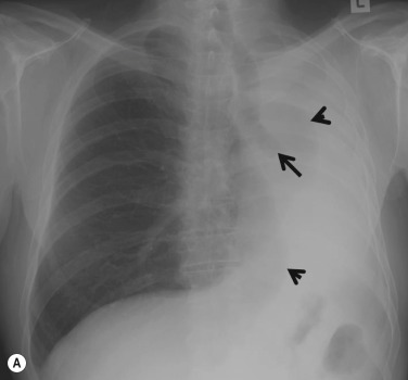 Fig. 7.1, Total Left Lung Collapse.