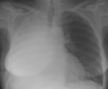 Fig. 7.2, Total Right Lung Collapse.